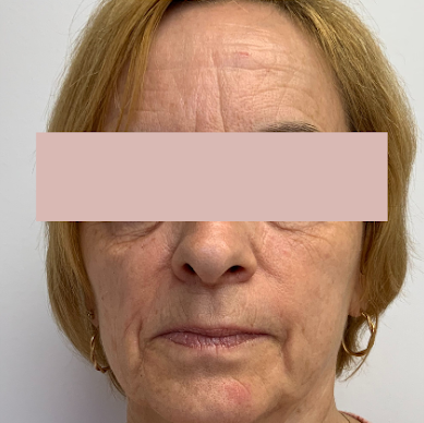 Avant EMFACE — Vue de face