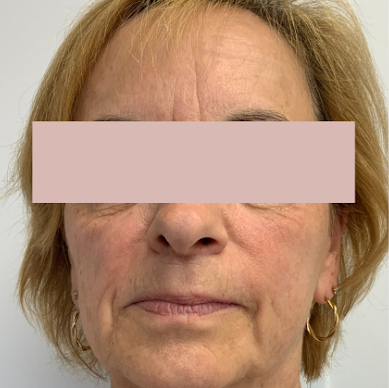 Après le traitement, photographie fournie avec masque de confidentialité